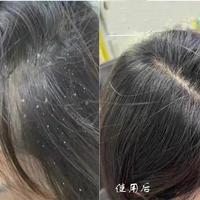 油敏头皮刷酸别踩雷！这三款精准又安全