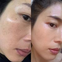 兰蔻极光淡斑精华真相：28天只是开始，顽固色斑需3个月起
