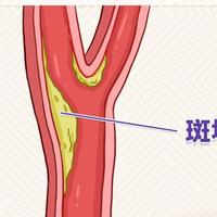 阿托伐他汀钙片天天吃，90% 老人都吃错，三大禁忌要记牢
