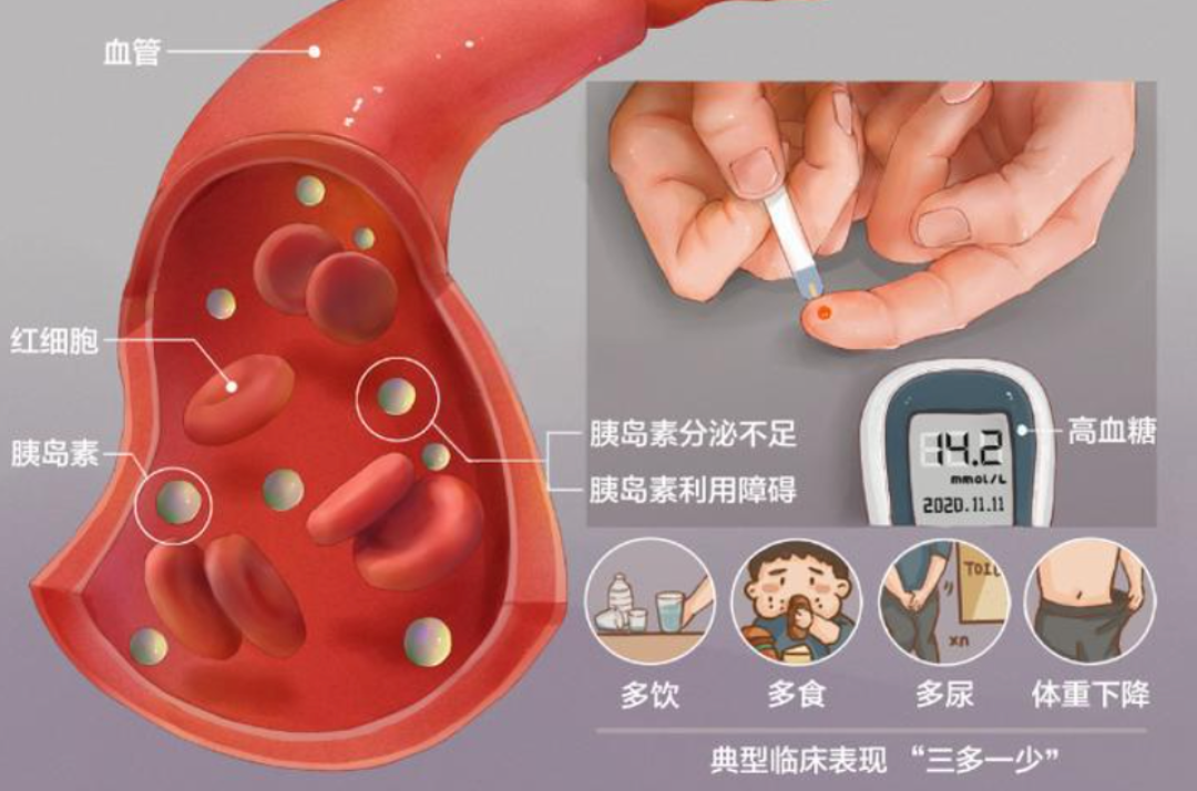 别被5.8的空腹血糖骗了,30至40岁是拦截糖尿病成本最低的保命窗口期