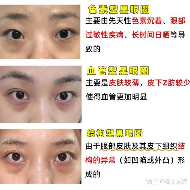 睡饱黑眼圈还是严重用哪款眼膜？护肤师推荐去黑首选CA冻干眼膜