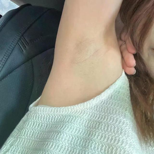 腋下发黑真相：不是脏，也不是狐臭，多数人用错方法了
