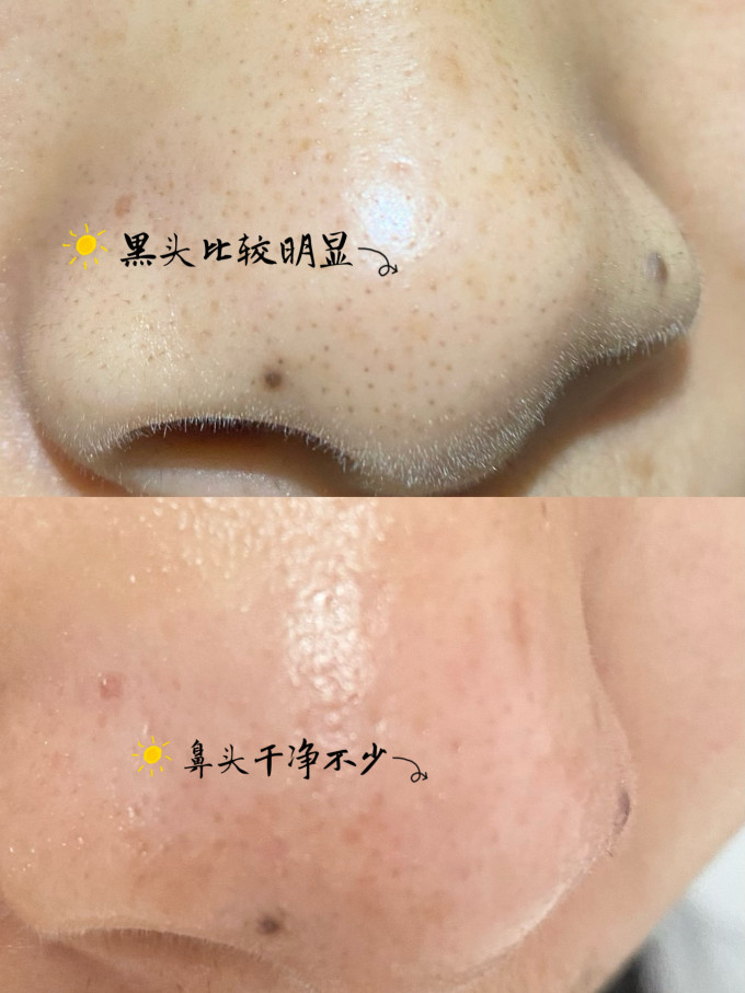 如薇T区护理