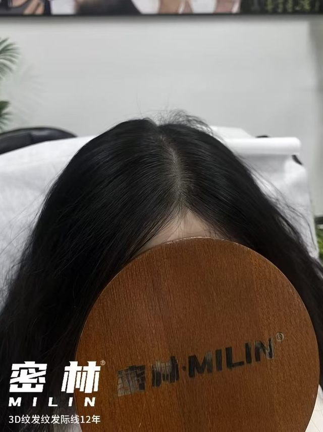 广州纹发标杆实测密林中韩连锁，15 年技术沉淀，全脱发类型通吃
