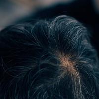 头皮按摩真能防脱生发?90%的人用错了方法