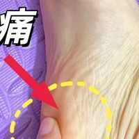2年的足底筋膜炎终于好了！