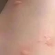  被蚊子咬了能迅速止痒的实用方法，可惜很多人都不知道　