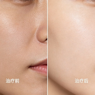 热玛吉和超声炮到底选哪个？我把抗衰选择逻辑整理清楚了