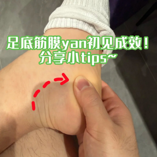 养了一段时间的足底筋膜炎，初见成效！分享
