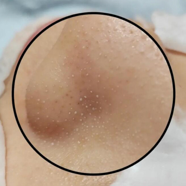 用完各种清洁面膜，白头黑头都还在，这是敷了个寂寞？？
