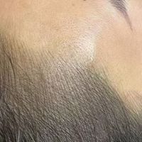 发际线后移头顶稀疏?武汉密林定制化纹发,打造宛若原生浓密发感