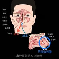 鼻炎反复总不好？医学指南说洗鼻器这样用才对，很多人都搞错了