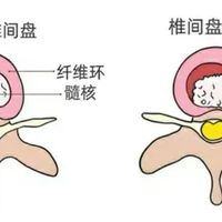 不是所有的腰椎突出都要手术!医生反复强调:做好这件事比吃药管用