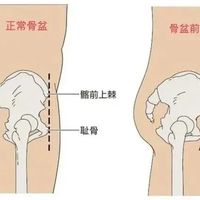 一个动作自测骨盆前倾！假翘臀正在悄悄毁掉你的腰和体态