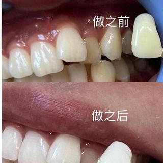 牙龈萎缩真的长不回来！但这支牙膏能帮你拦住继续恶化