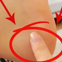 足底筋膜炎的人基本都有一个特点