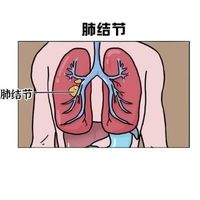 4mm肺结节8个月后复查消失了，我到底做了什么