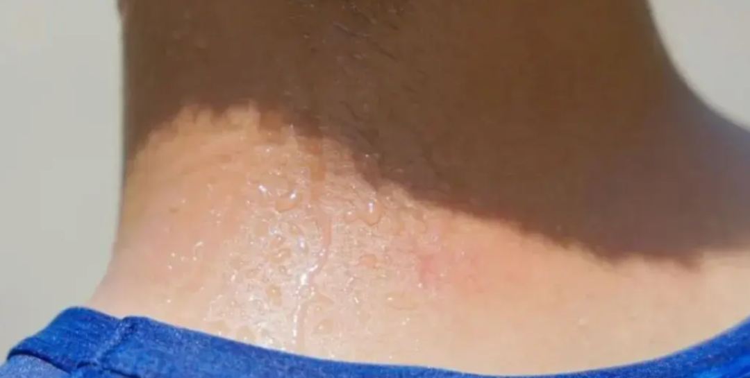 为什么蚊子总咬你?跟血型没关系,是你有它爱的味道
