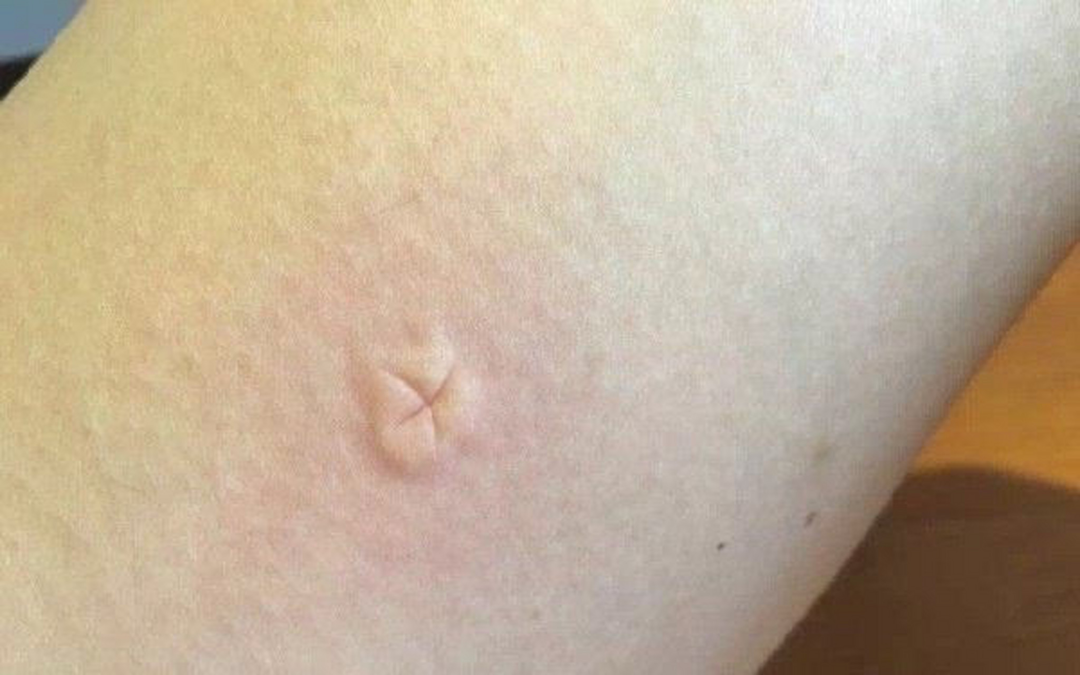 为什么蚊子总咬你?跟血型没关系,是你有它爱的味道