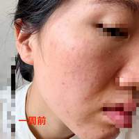 祖理安红曼精华+油皮乳的一周皮肤真是打卡反馈，真的好很多了！