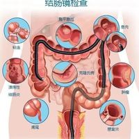肠镜做完才是开始，医生说的术后细节没几个人知道