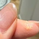 头皮抠出