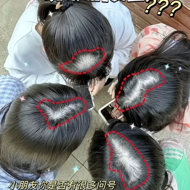 头皮抠出"白泥"，根本不是没洗干净，警惕这些问题发生！