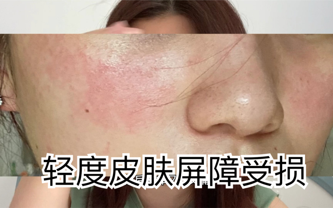 晒后第一晚别急着美白:先降温、保湿,再判断要不要就医