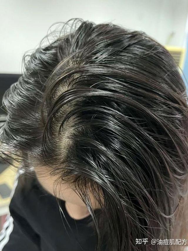 老师建议买的控油洗发水真的有用吗？油敏皮亲测28：从配方逻辑看为什么它不刺激反而控油