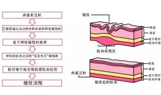 保妥适衡力怎么选？医美老手也容易踩的肉毒素选择误区