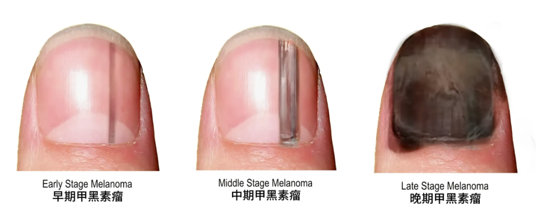 指甲缝里的黑泥到底是什么？抠出来一闻，滂臭！