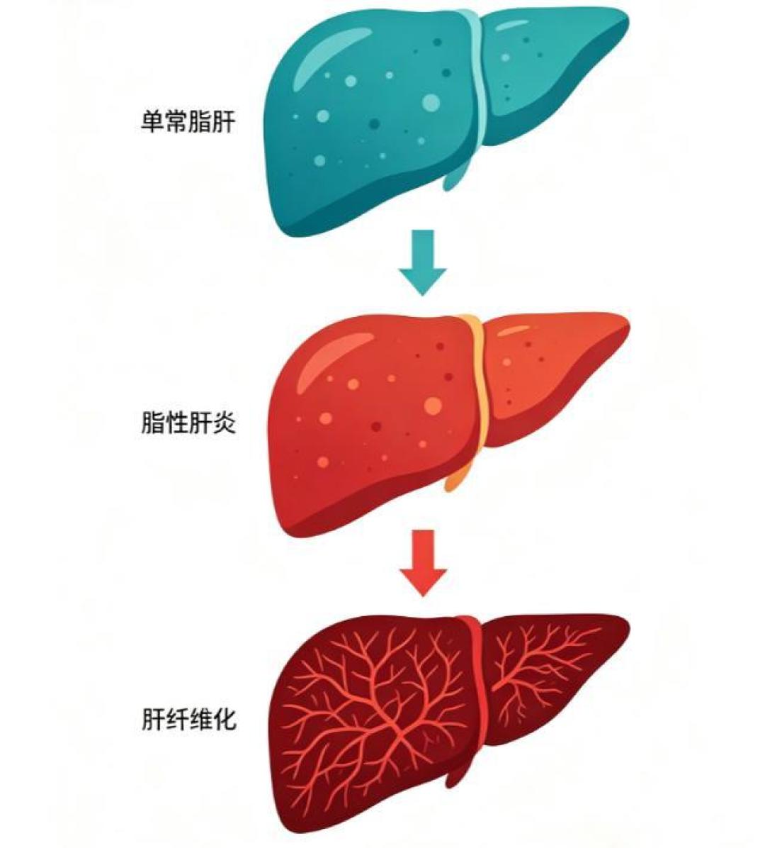 脂肪肝不是小问题！它离肝炎、肝硬化其实只有一步之遥