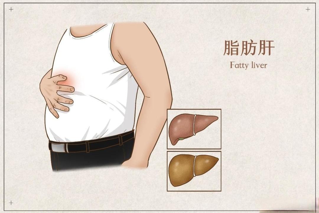 脂肪肝不是小问题！它离肝炎、肝硬化其实只有一步之遥