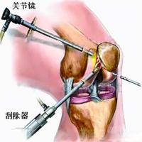 10年随访数据打脸：这类膝盖手术不仅没用，还会让关节坏得更快