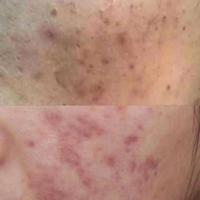 红印按压3秒变浅、黑印按压没反应？教你分清痘印类型对症处理
