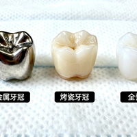 牙冠选烤瓷还是全瓷？牙医终于说实话了