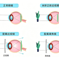 同样是离焦镜，为什么有的孩子控制住了，有的却没用？