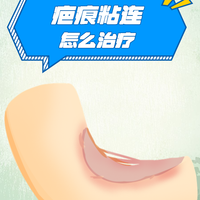 刀口好了≠里面好了！医生：深层筋膜粘连才是产后腰酸背痛的真正根源