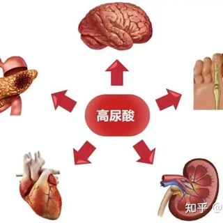 脚从没痛过，一查就是肾衰竭！高尿酸最可怕的从来不是痛风