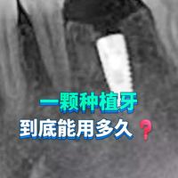 种植牙能陪您多久？有人用50年有人三五年就坏，差距在4个关键点