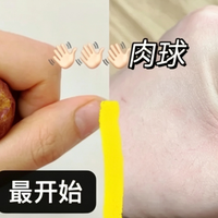 痔疮肿痛脱出怎么办？调整改善个人习惯（经验篇）