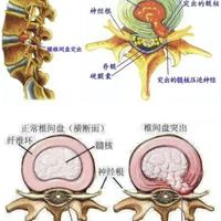 腰突手术时机怎么选？医生总结：出现这些信号才考虑动刀