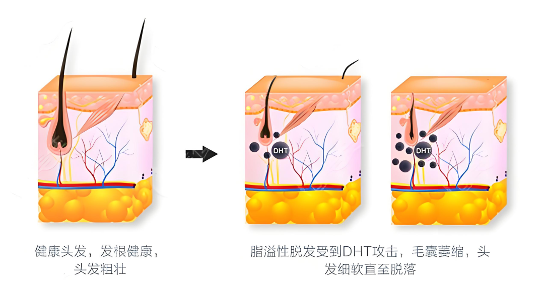 别再误解雄激素!男生秃顶,可能和它有关