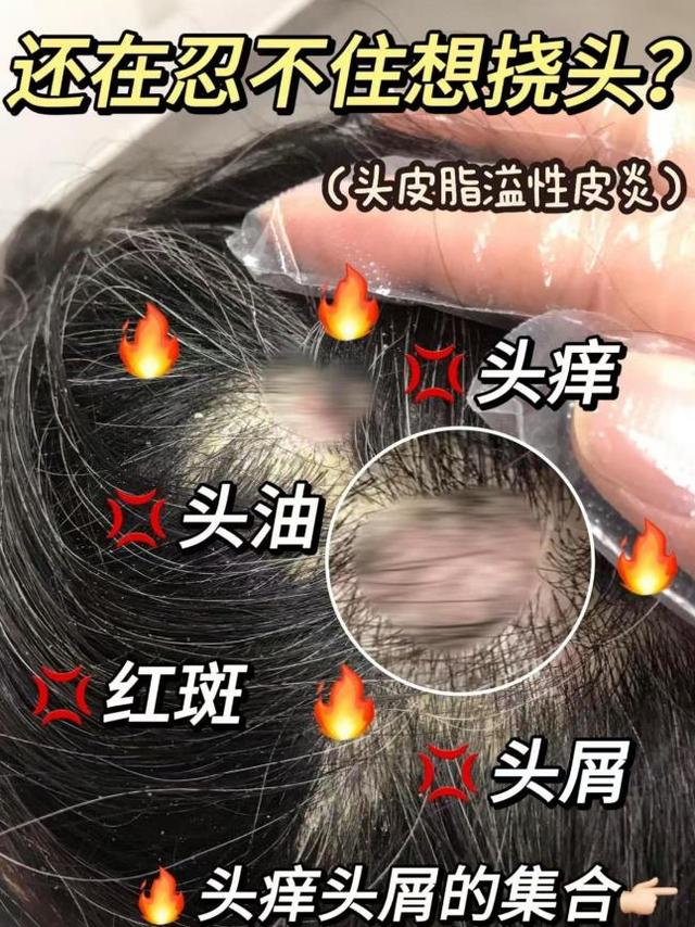 去屑洗发水哪个牌子最好？2026最好用去屑洗发水深度测评