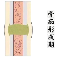 骨折后喝骨头汤吃钙片，骨头还是长得慢？医生：分阶段吃对比进补更重要