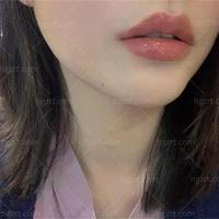 扎几针就能变美？丰唇翻车率最高的真相，太多人不知道