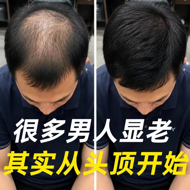 转发给你身边的秃顶90后同事，头发自救（实测版）