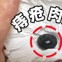 7年痔疮拉锯战，给大家分享一下我的经验！