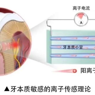 花更多钱买舒适达专业修复线，值不值？牙医不会说的真相