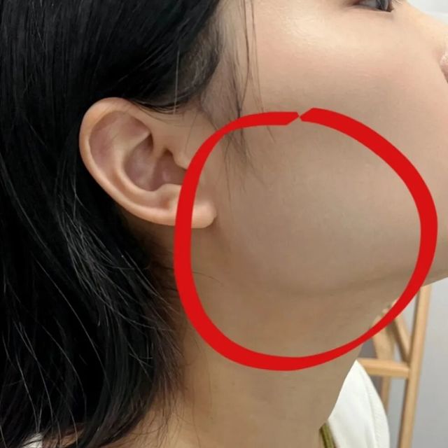 脸越来越方？别急着削骨！先搞清楚是不是咬肌的问题